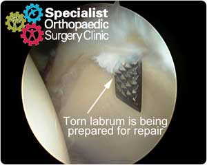ar-labral-repair-300