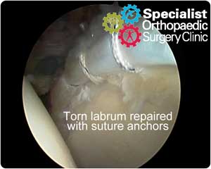 ar-labral-repair03-300