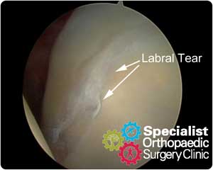 ar-labral-tear-300