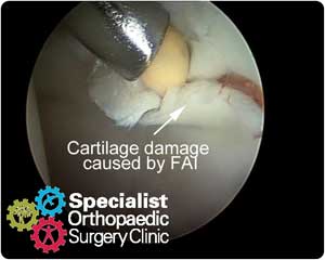 ar-rim-lesion01-300