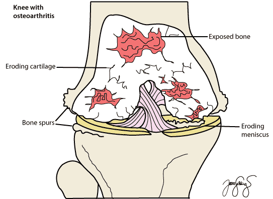 di-knee-osteoarthritis