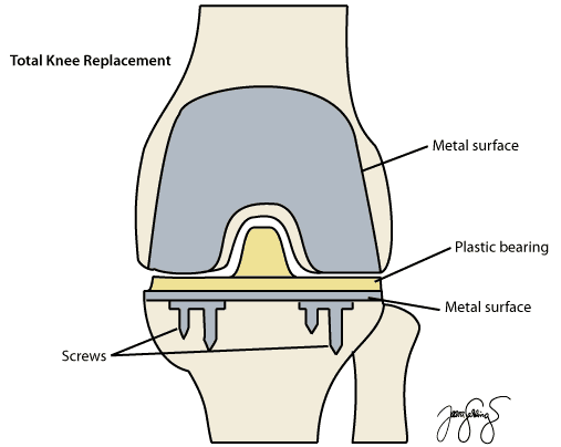 di-knee-total-repl-c-label4