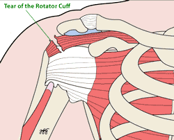 di-shoulder-rotatorcufftear-250
