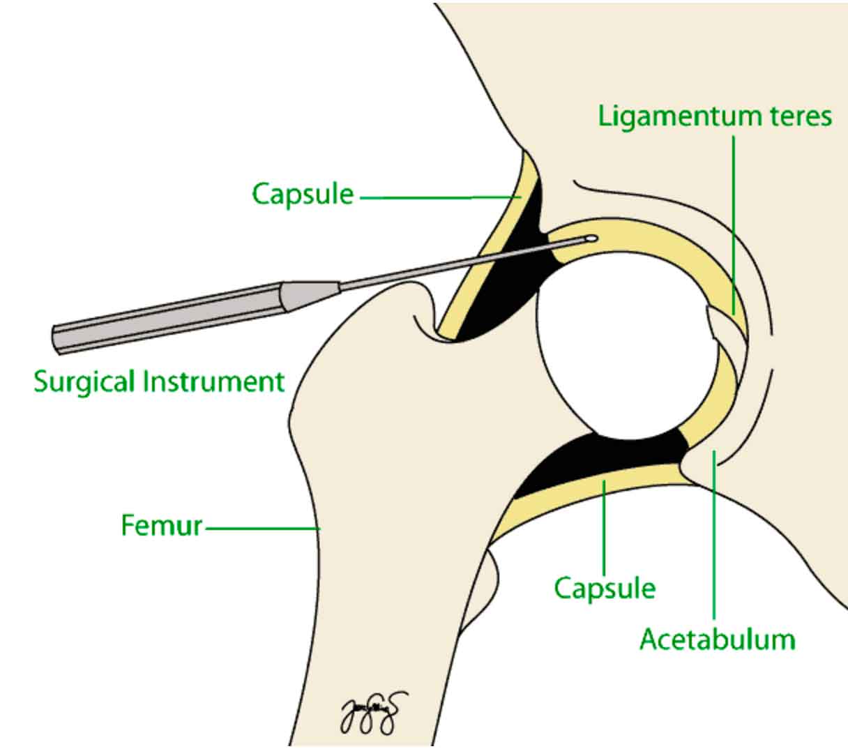 Hip Arthroscopy Sos Clinic