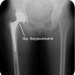 Anterior hip replacement