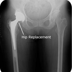 xr-hip-thr-hybrid-ap-250-label