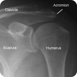 xr-shoulder-ap-normal-250-label