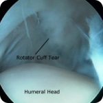 Rotator cuff tear