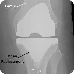 xr-knee-tkr-ap-250-label